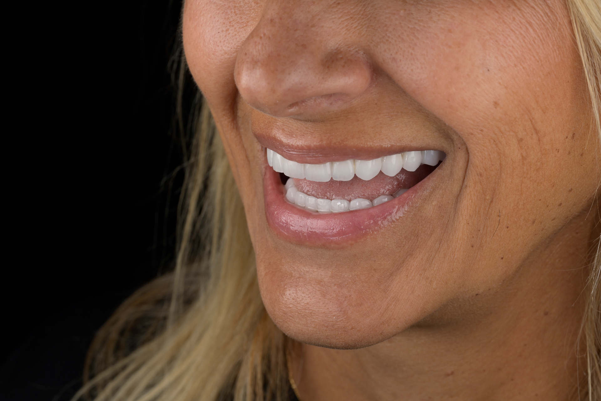 Detail of a bright, natural-looking smile showing restored tooth length and balanced proportions