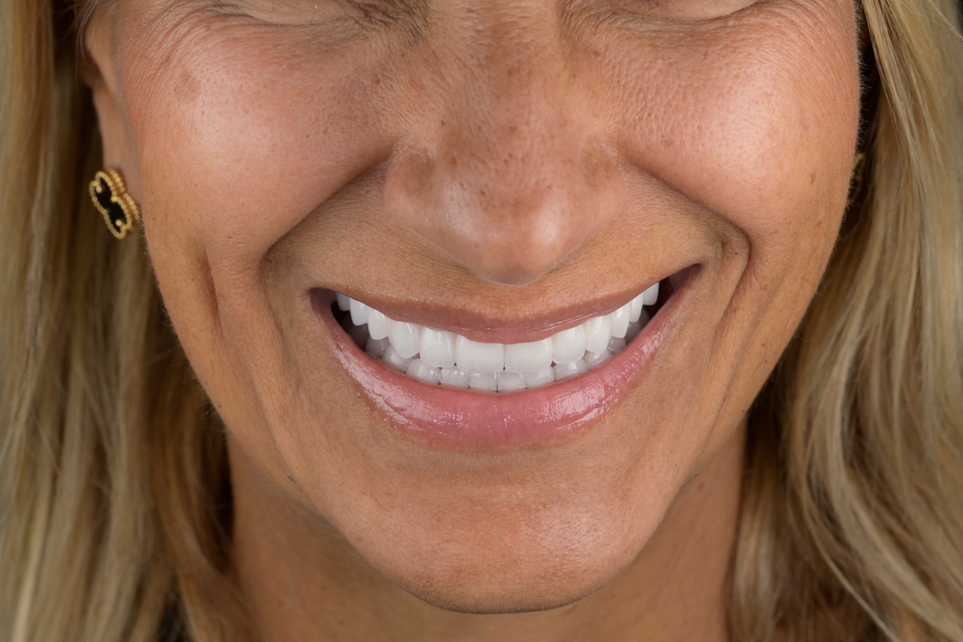 Full, natural smile showing the artistry of a well-designed cosmetic dentistry result