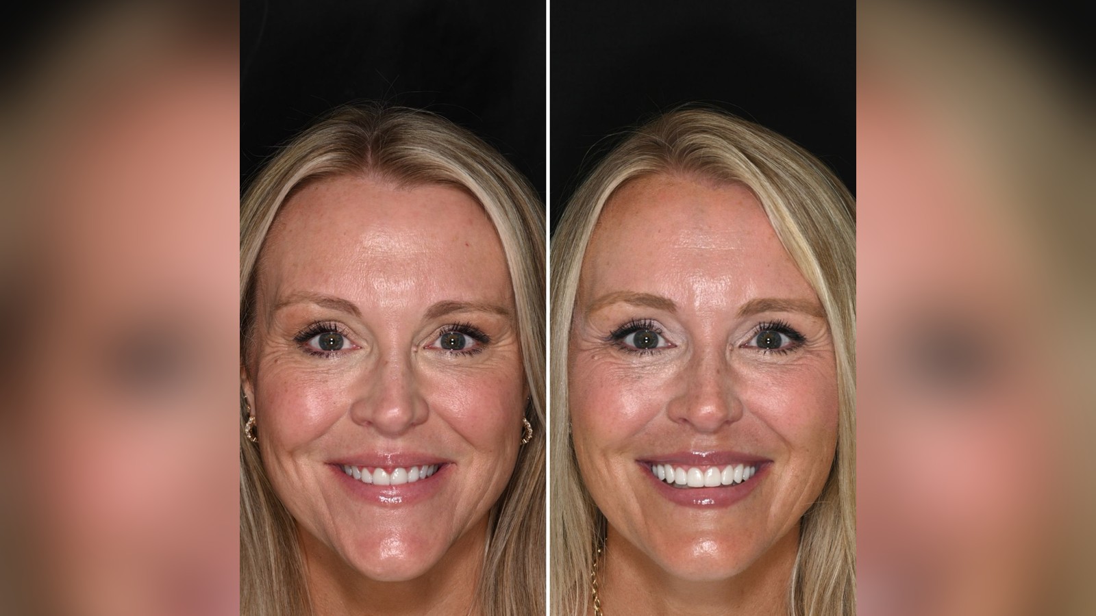 Before and after smile makeover results from Dr. Vince Avallone showing a lifted lower face and fuller lips