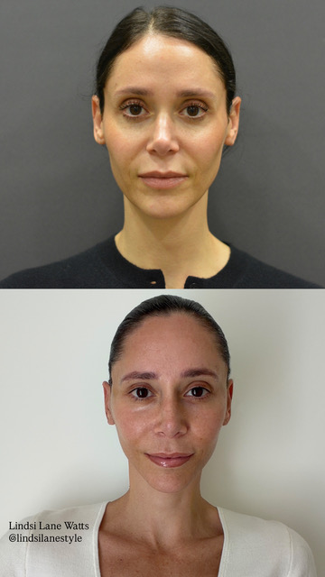 Deep plane facelift before and after results by Dr. Sam Rizk in New York
