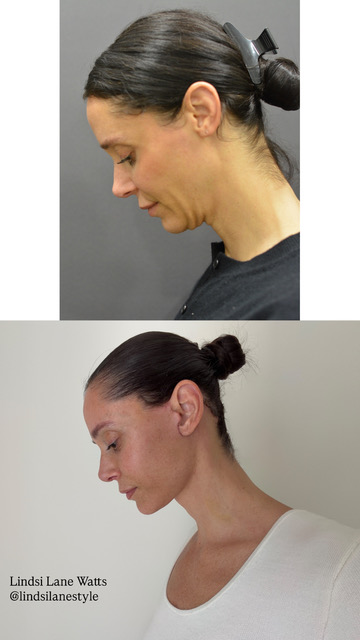 Facial rejuvenation before and after photos from Manhattan Facial Plastic Surgery