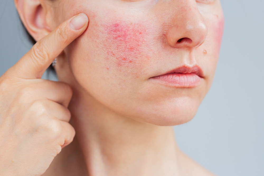 What's Actually New in Rosacea Treatment Right Now